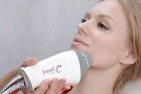 cewhera pêvajoya nûvekirina çermê ya fraksîyonel